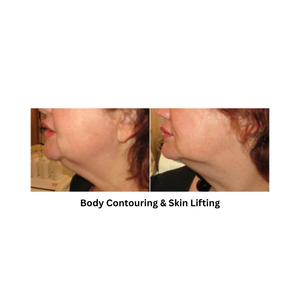 Body Shape RF result after body contouring and skin lifting procedure