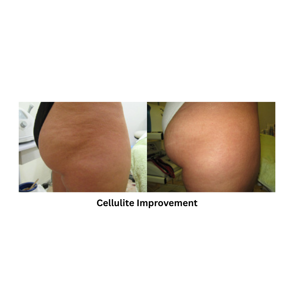 Body Shape RF result after cellulite improvment procedure