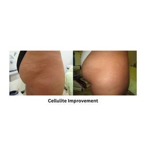 Body Shape RF result after cellulite improvment procedure