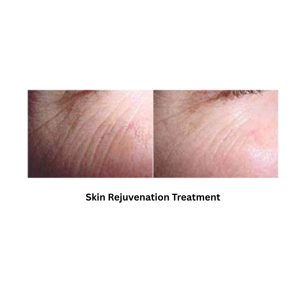 Body Shape RF result after skin rejuvenation procedure