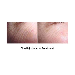 Body Shape RF result after skin rejuvenation procedure