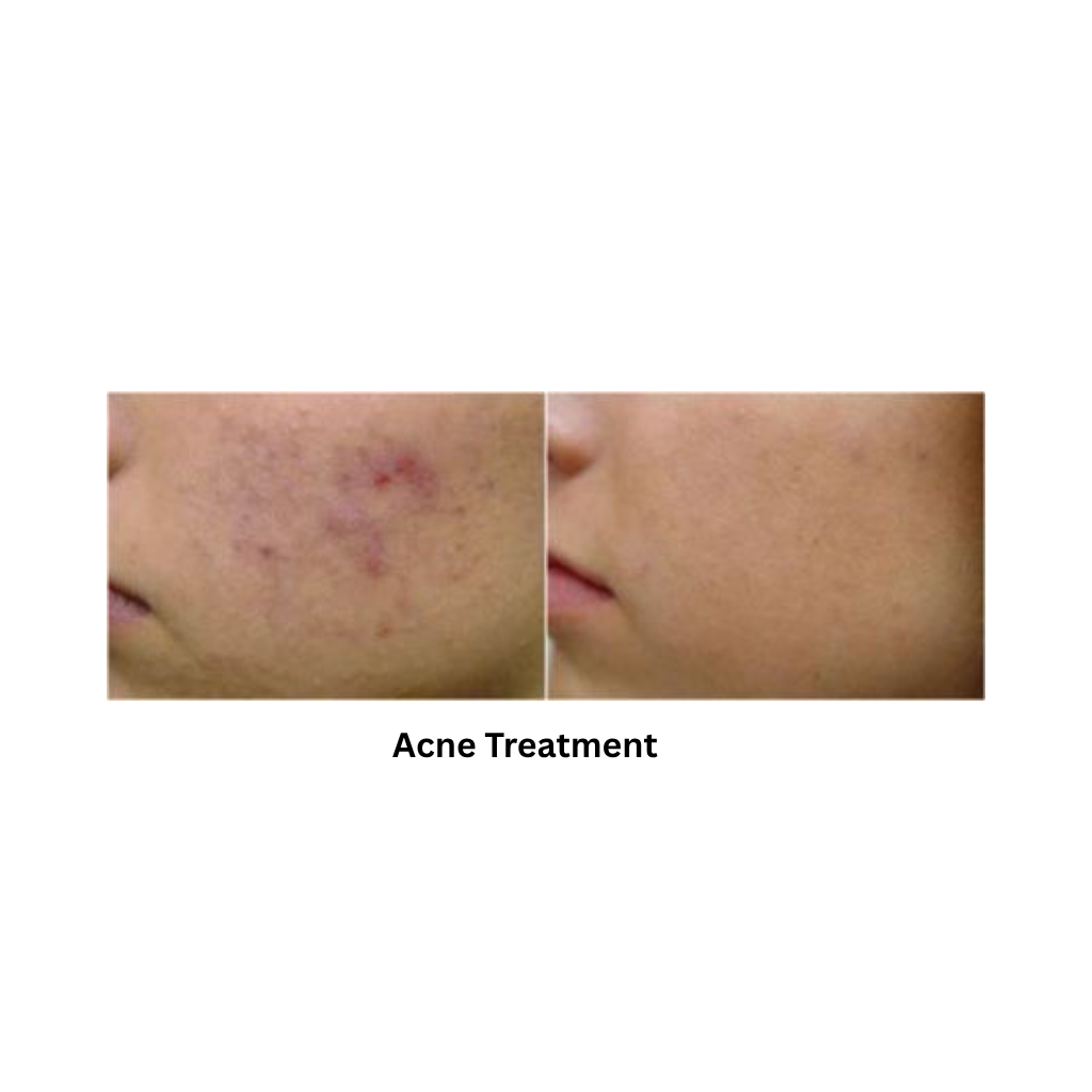 Extra 818 Hair Removal & Facial Treatment System showing the result in acne treatment