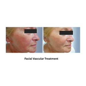 Extra 818 Hair Removal & Facial Treatment System showing the result in facial vascular treatment
