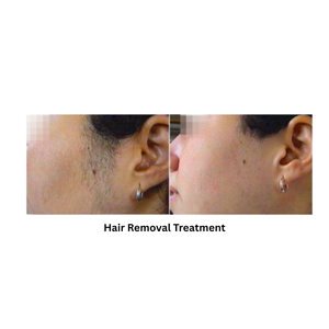 Extra 818 Hair Removal & Facial Treatment System showing the result in hair removal treatment