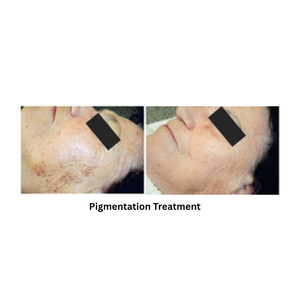 Extra 818 Hair Removal & Facial Treatment System showing the result in pigmentation treatment