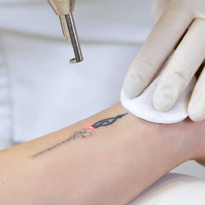 Silhouet-Tone Global Cure SC6 Tattoo Removal Being Used On Patients Skin