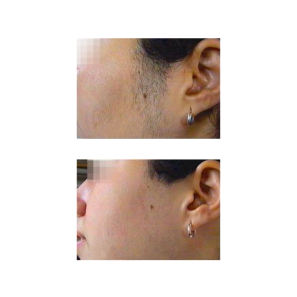 The Spirit Laser Hair Removal System illustrating results after the laser hair removal