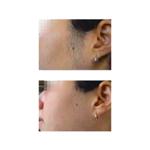 The Spirit Laser Hair Removal System illustrating results after the laser hair removal