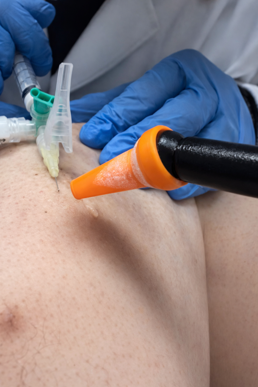 Close-up of a medical procedure with a needle and syringe on a person's arm, wearing blue gloves.